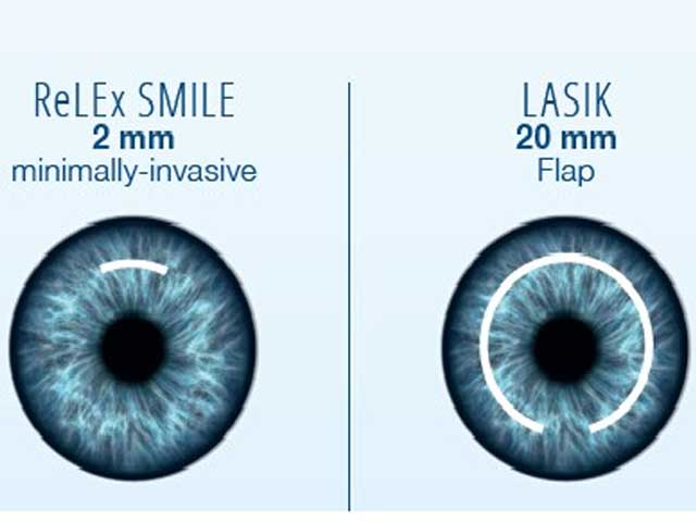 smile-lasik-eye-surgery