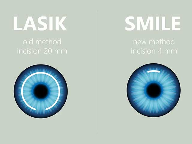 smile-vs-lasik-eye-surgery