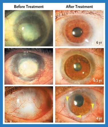 Best Eye Care Hospital in Kolkata - Cornea Treatment