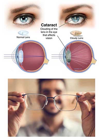Best Eye Care Hospital in Kolkata - Cataract Treatment