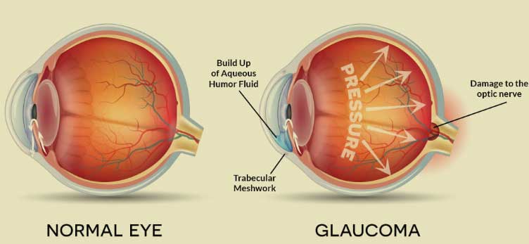 Best Eye Care Hospital in Kolkata - Glaucoma Treatment