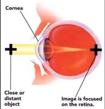 What is Lazy Eye or Amblyopia?