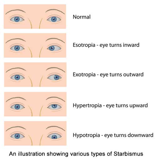 Best Eye Care Hospital in Kolkata - Paediatric Opthamologist